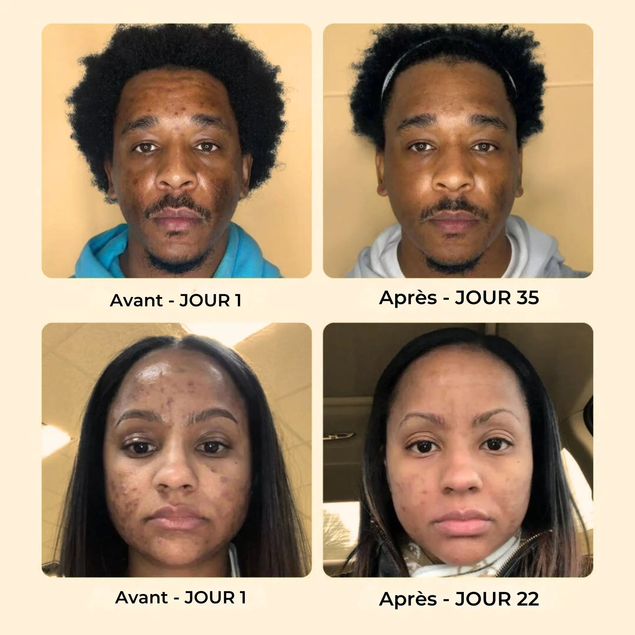 Savon Anti-Taches & Hyperpigmentation au Curcuma